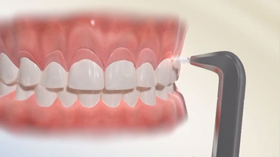 Laser Dentistry 