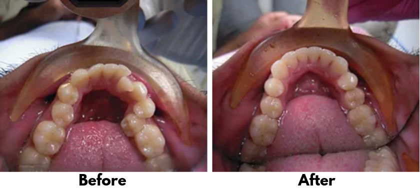 Invisalign Clear Braces - Weymouth, MA - Orthodontics