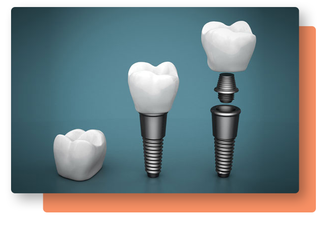Dental Implants