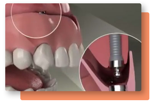 Implant Supported Dentures