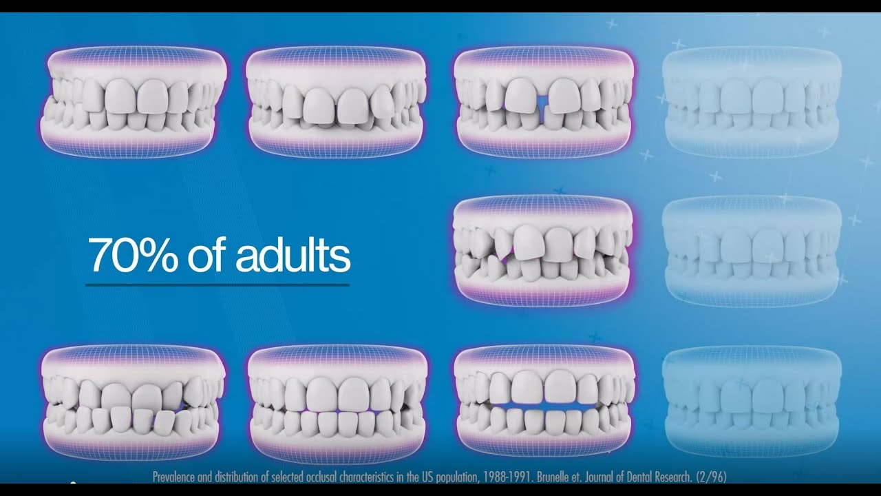Invisalign®